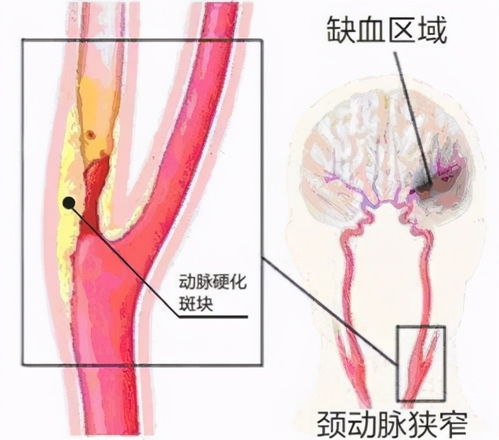 檢查頸動(dòng)脈注意事項