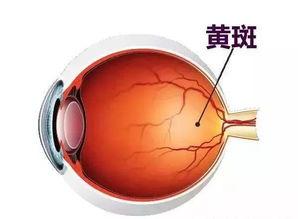 黃斑水腫有什么注意事項