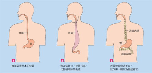 食道隆起esd手術(shù)后注意事項