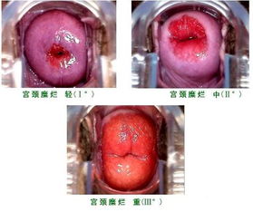 做完宮頸手術(shù)后注意事項,宮頸糜爛手術(shù)后注意事項有哪些,宮頸糜爛做了手術(shù)要注意什么