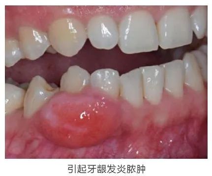 補牙后有什么注意事項