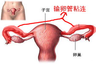 輸卵管粘連術(shù)后注意事項(xiàng)