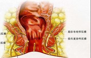 肛瘺術(shù)后上班注意事項