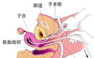 無痛打胎的注意事項,無痛微創(chuàng)包莖手術(shù)注意事項,無痛微創(chuàng)人流后注意事項
