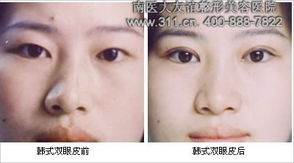 韓式微創(chuàng  )雙眼皮術(shù)后注意事項,韓式雙眼皮術(shù)后注意事項有哪些,雙眼皮術(shù)后注意事項及護理