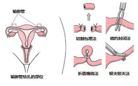結扎復通術(shù)后要注意什么,輸精管結扎術(shù)后注意事項,精索靜脈曲張結扎術(shù)后注意事項