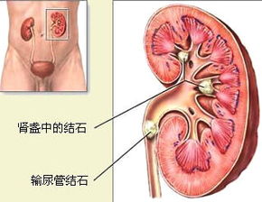 腎結石注意事項及飲食禁忌,腎結石日常生活注意事項,腎結石術(shù)后注意事項