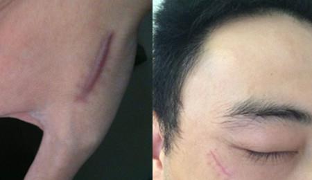 手切傷縫針后注意事項