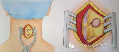 駝背手術(shù)需要注意事項