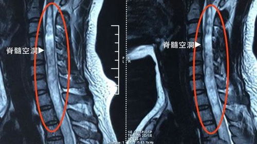 造影,脊髓,術(shù)后,注意事項