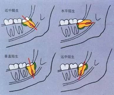 拔了阻生牙后注意事項