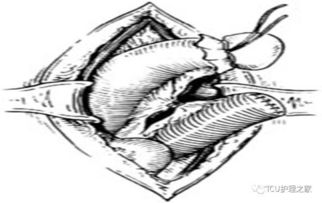 術(shù)后,注意事項(xiàng),患者,腸造瘺