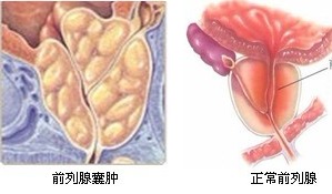 前列腺插管治療后注意事項
