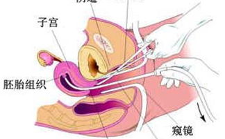 微創(chuàng)無痛打胎注意事項