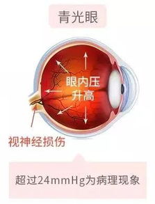 青光眼的日常注意事項,青光眼注意事項和飲食,青光眼術(shù)后3月注意事項