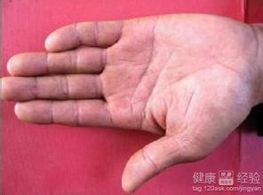 皮下結節注意事項