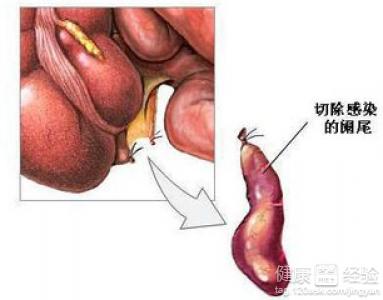 闌尾炎切除后飲食注意事項