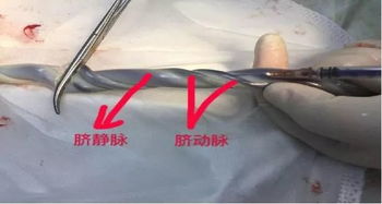抽取血氣分析注意事項