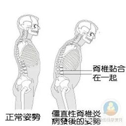 置換關(guān)節(jié)術(shù)后注意事項