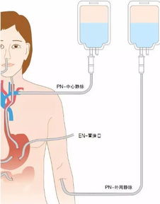 腸外營(yíng)養支持的注意事項