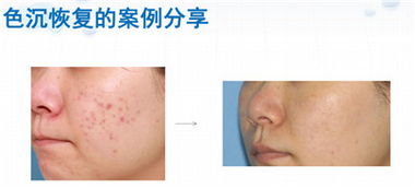 激光術(shù)后應該注意些什么,激光手術(shù)后需要注意什么,激光治療后注意事項