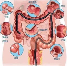 腸鏡檢查前注意事項有哪些,腸鏡檢查后注意事項,胃鏡腸鏡檢查前后的注意事項有哪些?