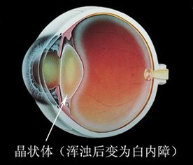 白內障注意事項和飲食,術(shù)后白內障注意事項,白內障日常注意事項