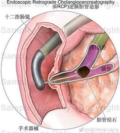 膽道結石術(shù)后注意事項