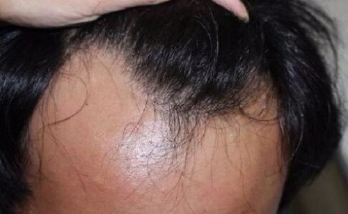 植發(fā)前后要注意什么,染頭發(fā)前后注意事項,燙頭發(fā)前后注意事項