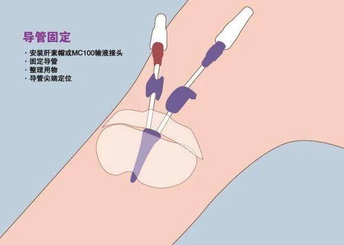 picc置管術(shù)注意事項,picc置管期間注意事項,Picc置管注意事項
