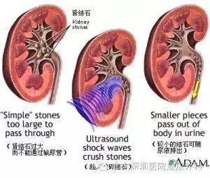 沖擊波,碎石,體外,注意事項