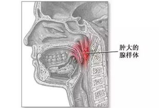 小兒腺樣體肥大的基礎知識